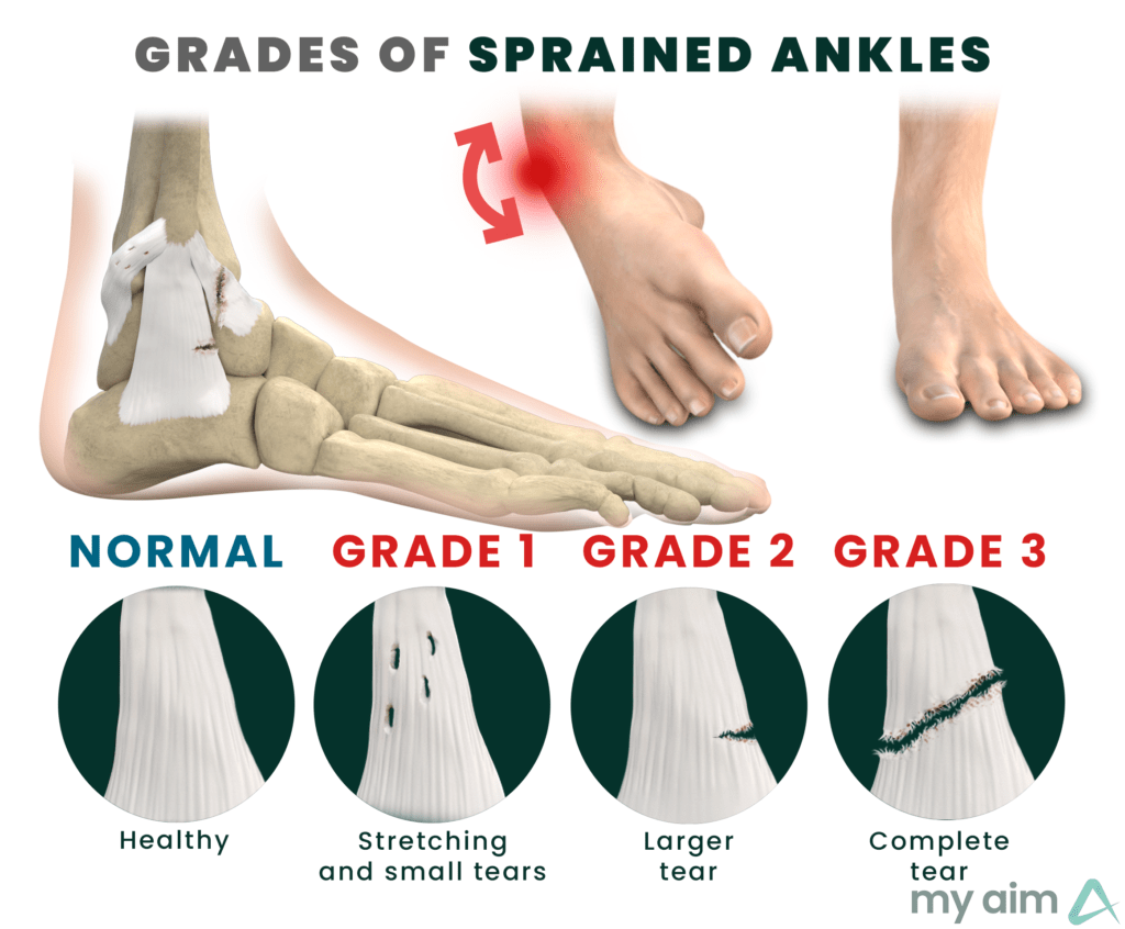Sprained Ankle - My Aim