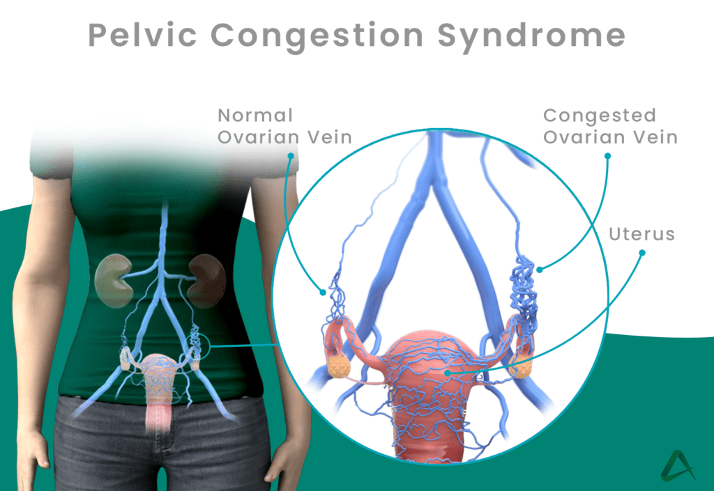 Pelvic Congestion AZ and Texas - My Aim